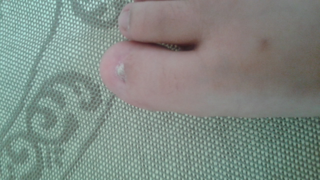 拔去的脚趾甲可以怎么修复? - 医学 - 知乎