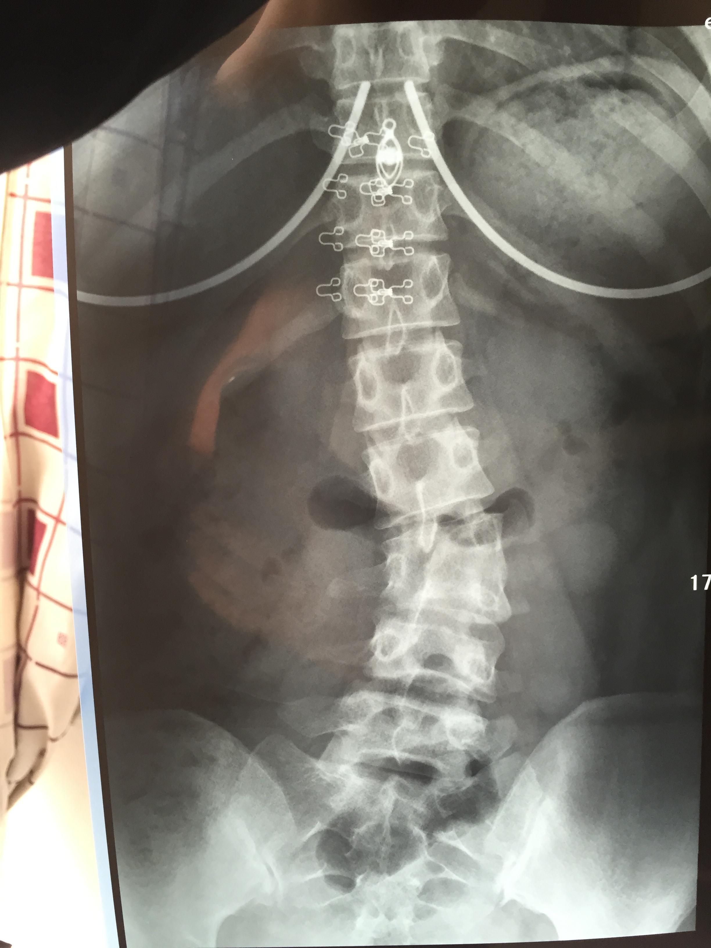 腰椎侧弯,l3椎体右侧明显变扁,求治疗方案?