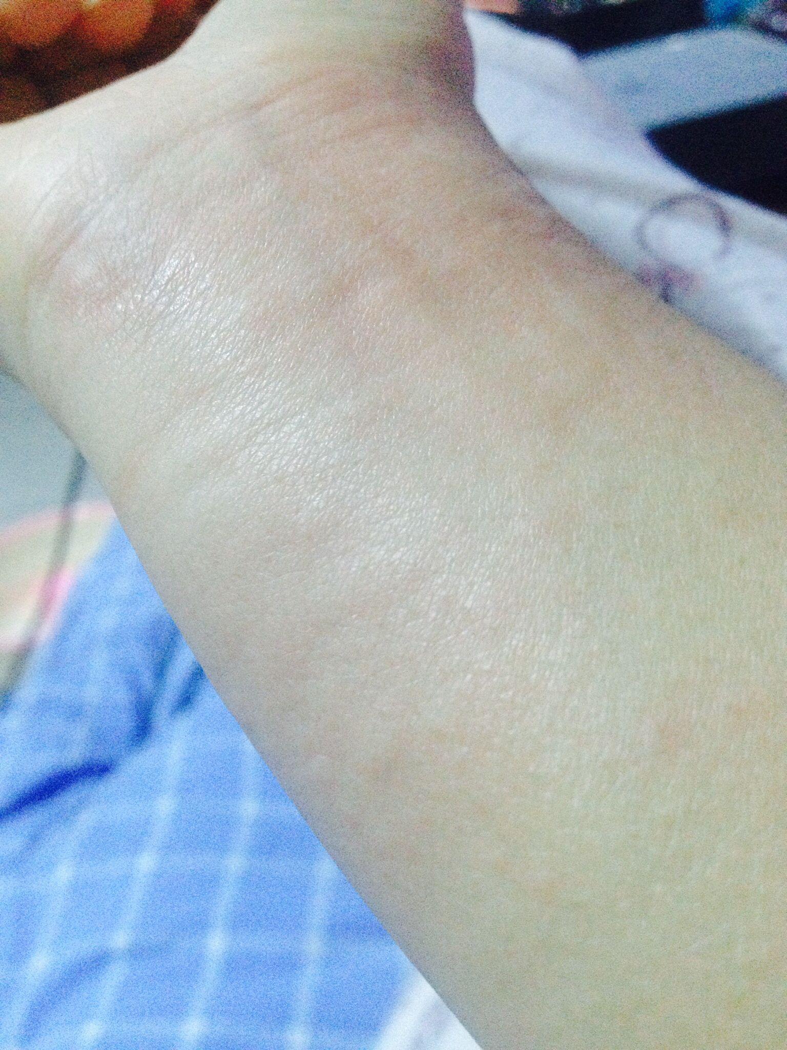 荨麻疹和湿疹的分别? - 霍瑞的回答 - 知乎