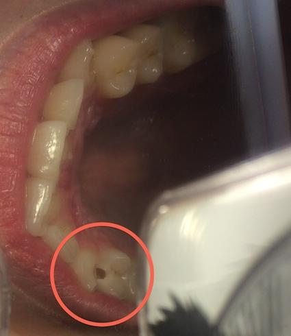 浅龋齿一定要补吗?