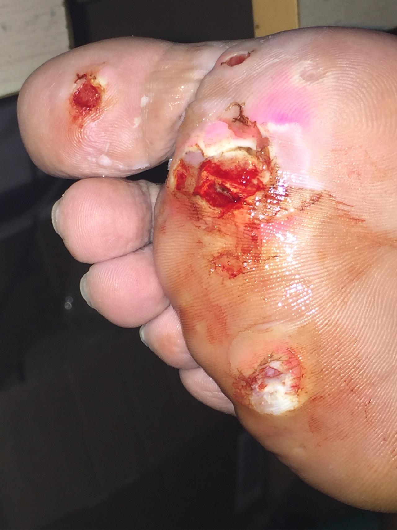 一年多了,我终于把这些折磨我的鸡眼连根拔起!