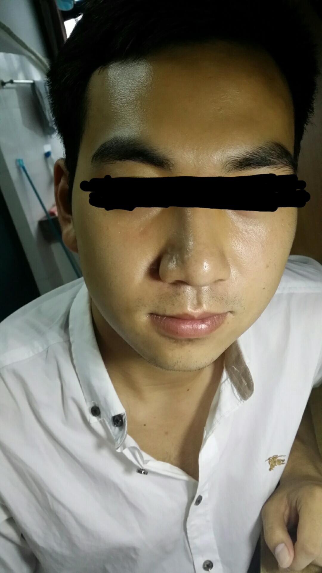 男士痘印如何祛?以及请推荐合适的水乳 - 匿名