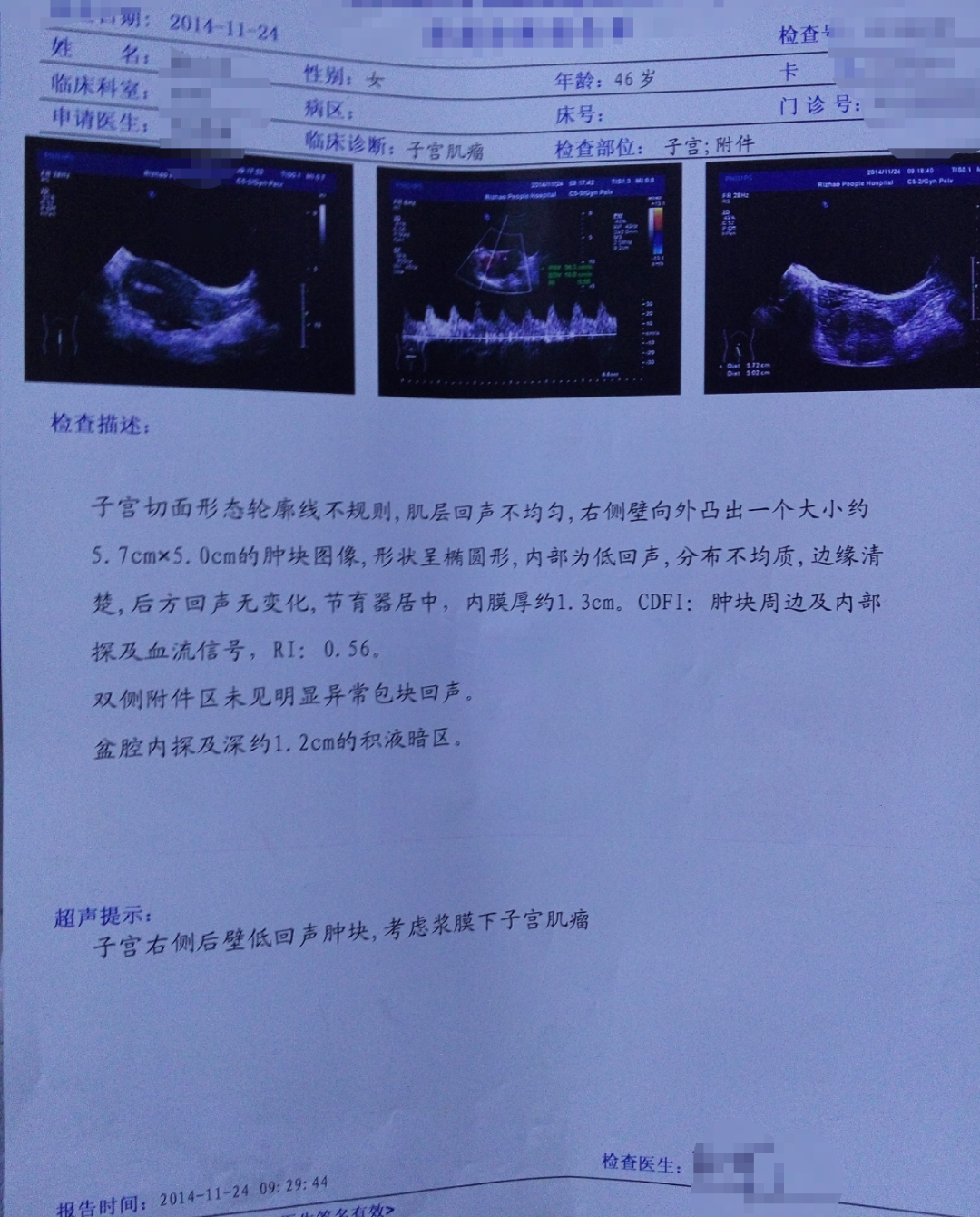 求助关于子宫肌瘤如何治疗?