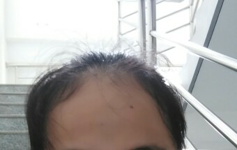 女生额头大而且<em>碎头发多</em>且有点卷怎么办 ? - 发