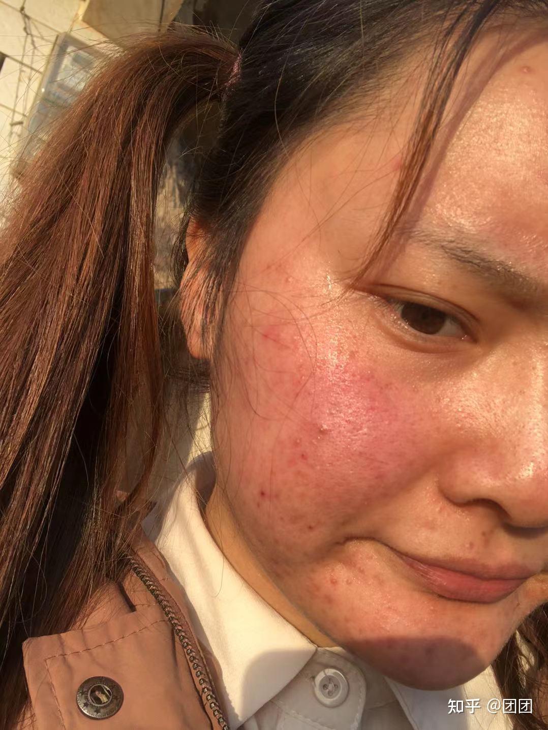 学生党激素脸痘痘脸的6年恢复过程