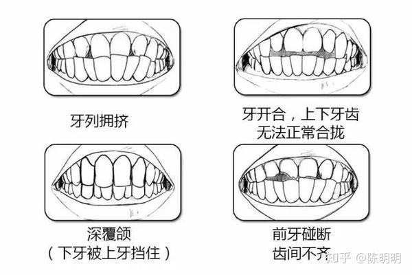 你需不需要做牙齿矫正自测一下不就知道了