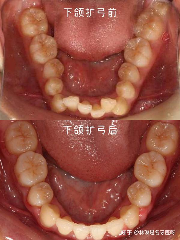 牙弓窄的患者,扩弓矫正后,不仅牙齿能够排齐,笑容也会饱满很多哦.