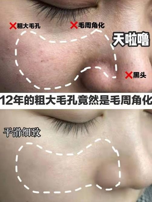 太可怕了,导致毛孔粗大的原因竟然是毛周角化