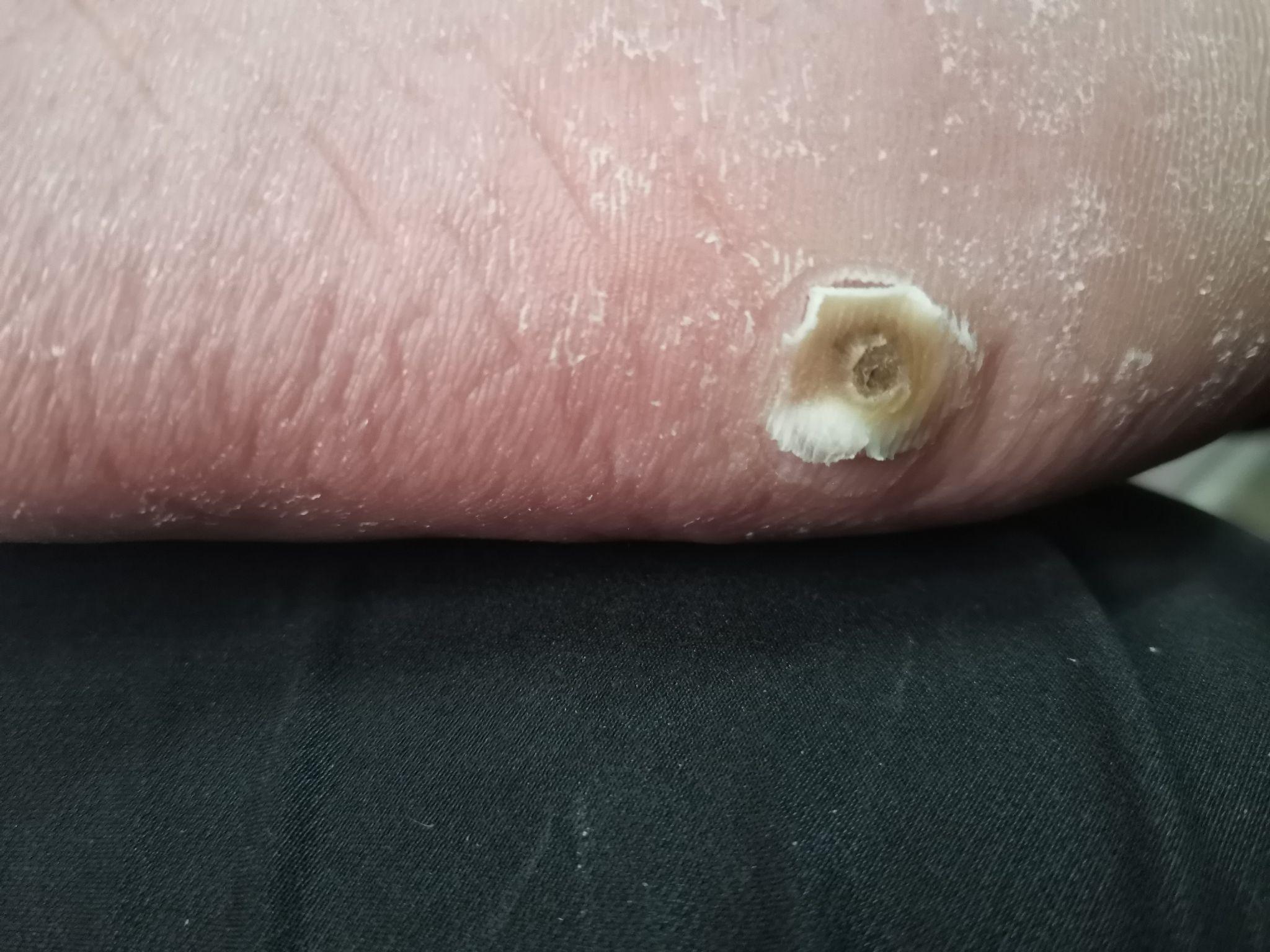 得了趾疣是一种什么样的体验怎么样才能治好
