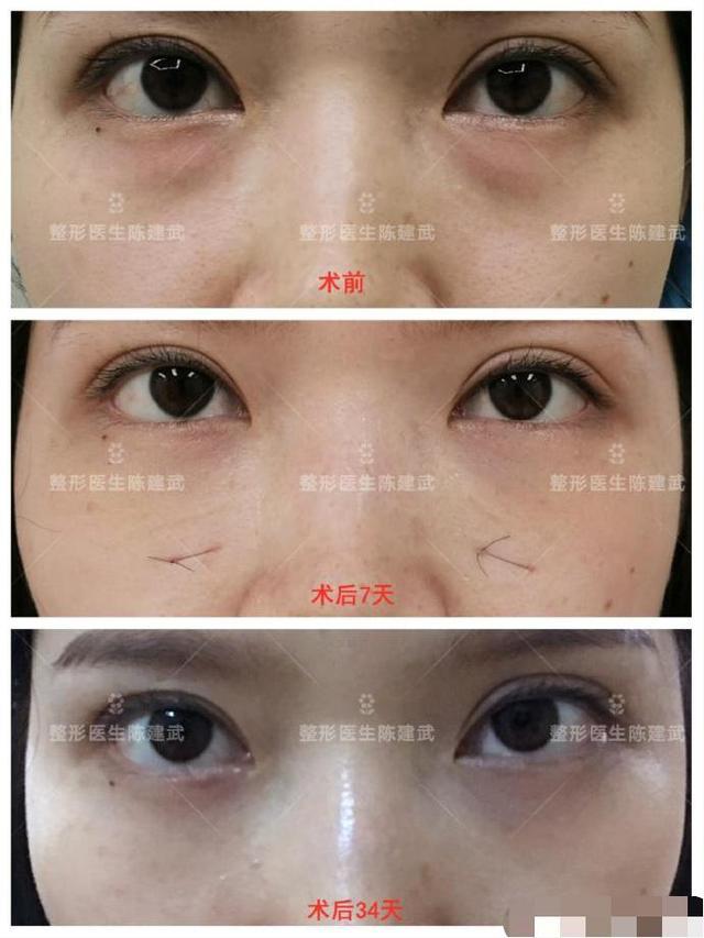 内切眼袋 眶隔脂肪释放手术,第七天完全恢复!
