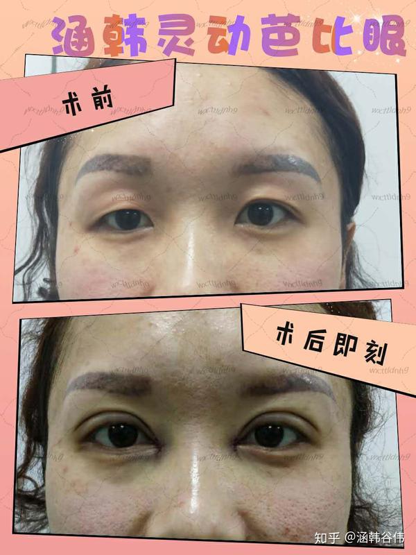 ↓ 效果还是很好的(^_^) 二,埋线双眼皮 埋线双眼皮是根据求美者关于