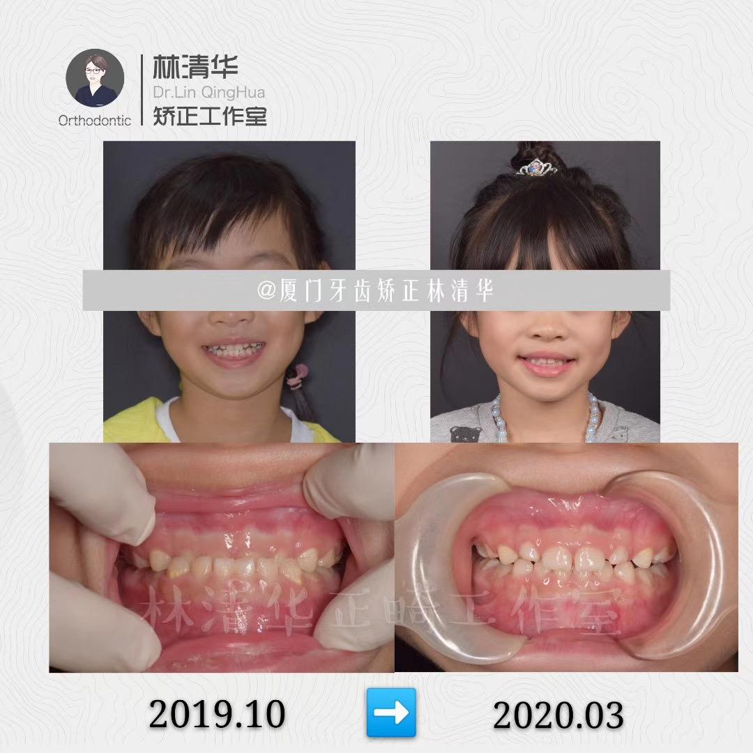 厦门牙齿矫正林清华:『孩子牙不齐 矫正越早 效果越好