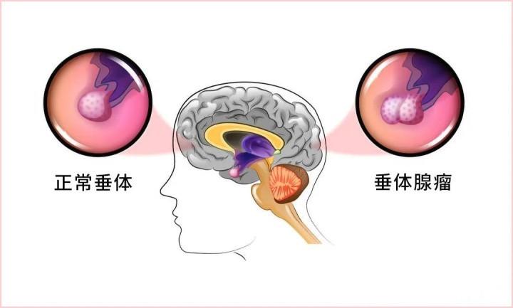 【疾病科普】泌乳素型垂体瘤临床上都有哪些治疗方法?