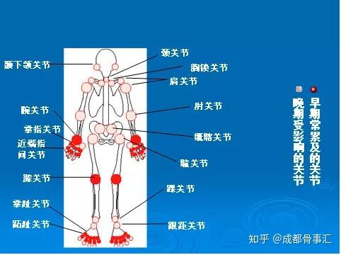 风湿关节痛是类风湿关节炎?