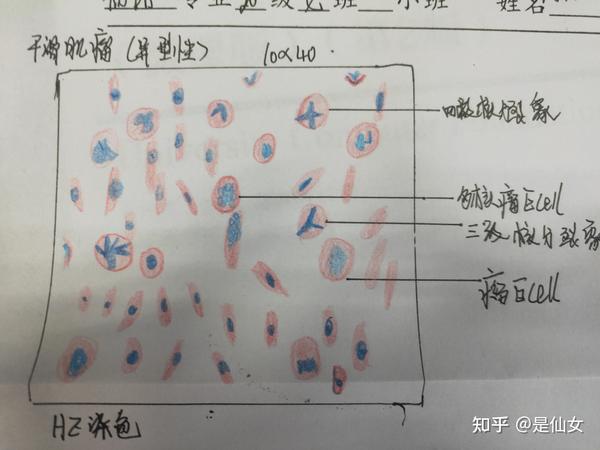 病理学红蓝铅笔绘画图 实验课题: 平滑肌瘤与鳞状上皮