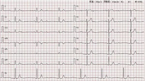 心电图图库丨高度三度房室传导阻滞系列