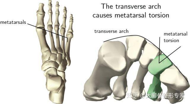 足横弓但是出现拇外翻以后,由于第一跖骨外旋,大拇趾向外旋,导致第一