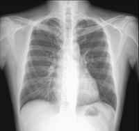 胸部ct和胸片哪个更准确,8个月前胸片正常,为什么现在肺癌晚期