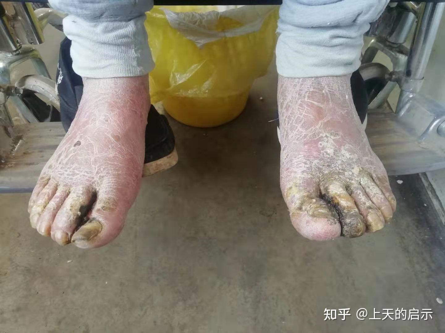 怎么能防止糖尿病足的发生