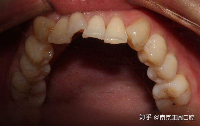 南京牙齿矫正哪里好南京自锁托槽9800全包价