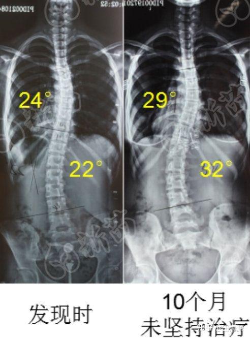 脊柱侧弯从20恶化到30只需要10个月