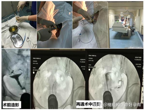 子宫输卵管造影(hsg)是推荐常用的 输卵管通畅度检查的方法.