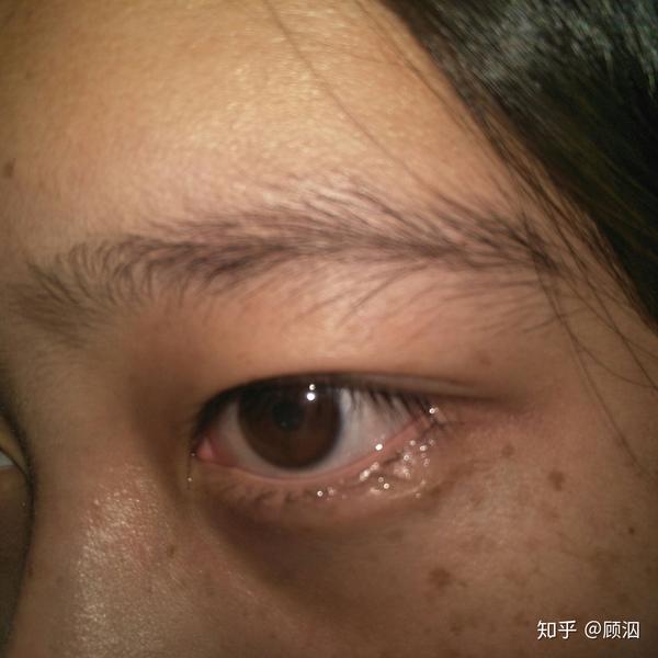 斑的位置主要是在眼角
