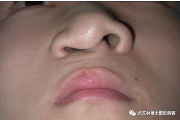 由于许多患者在唇裂修复术和其他可能的中期手术过程中已进行了唇裂鼻