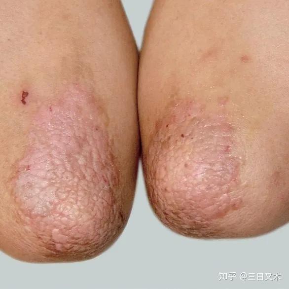 瘙痒症:通常皮肤表面看上去完好无损(抓痕除外),但就是很痒,患者不停