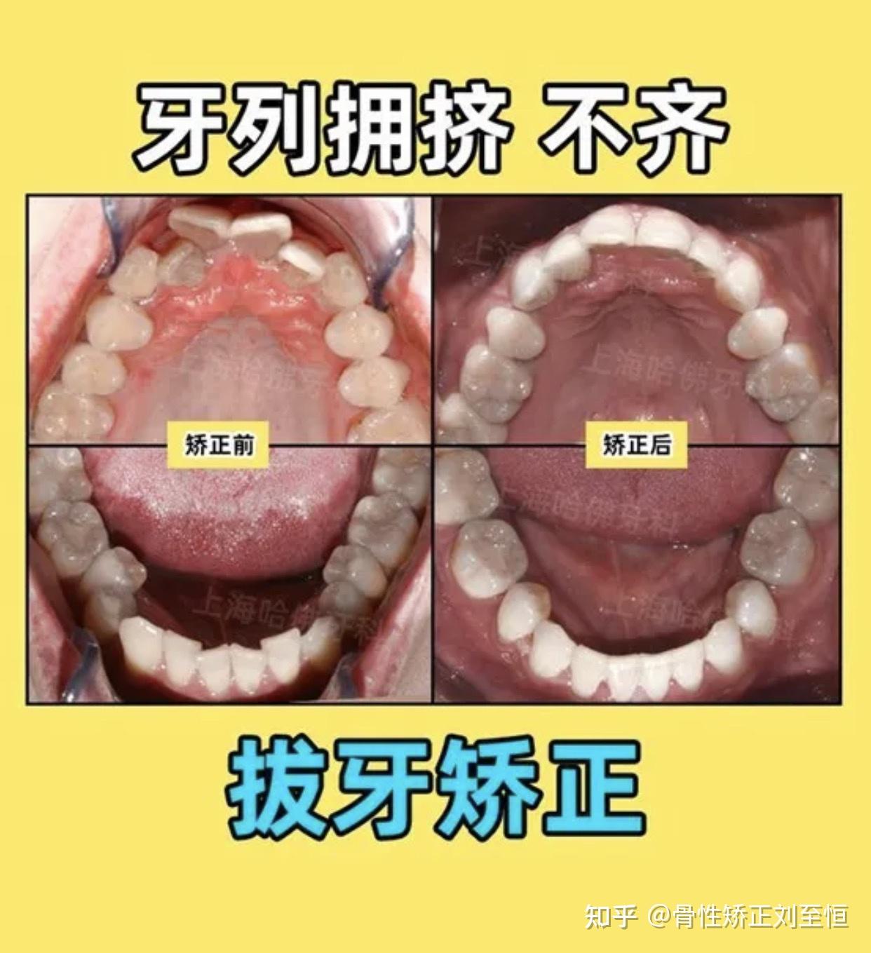 嘴巴闭合时下牙齿在外面为什么我看别人的都是上牙在外面该怎么解决