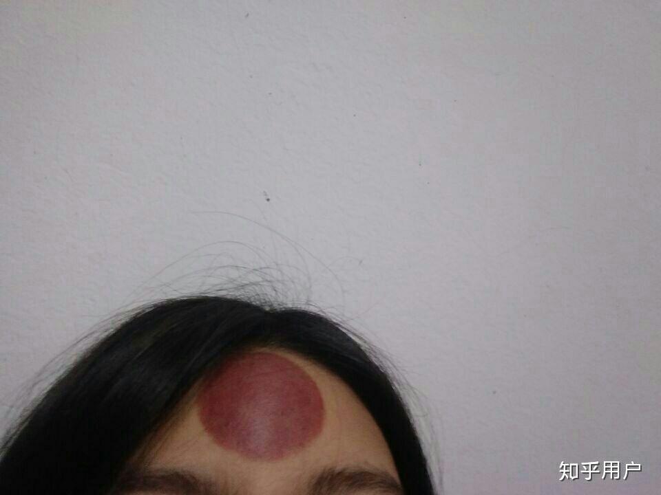 额头可以拔罐吗