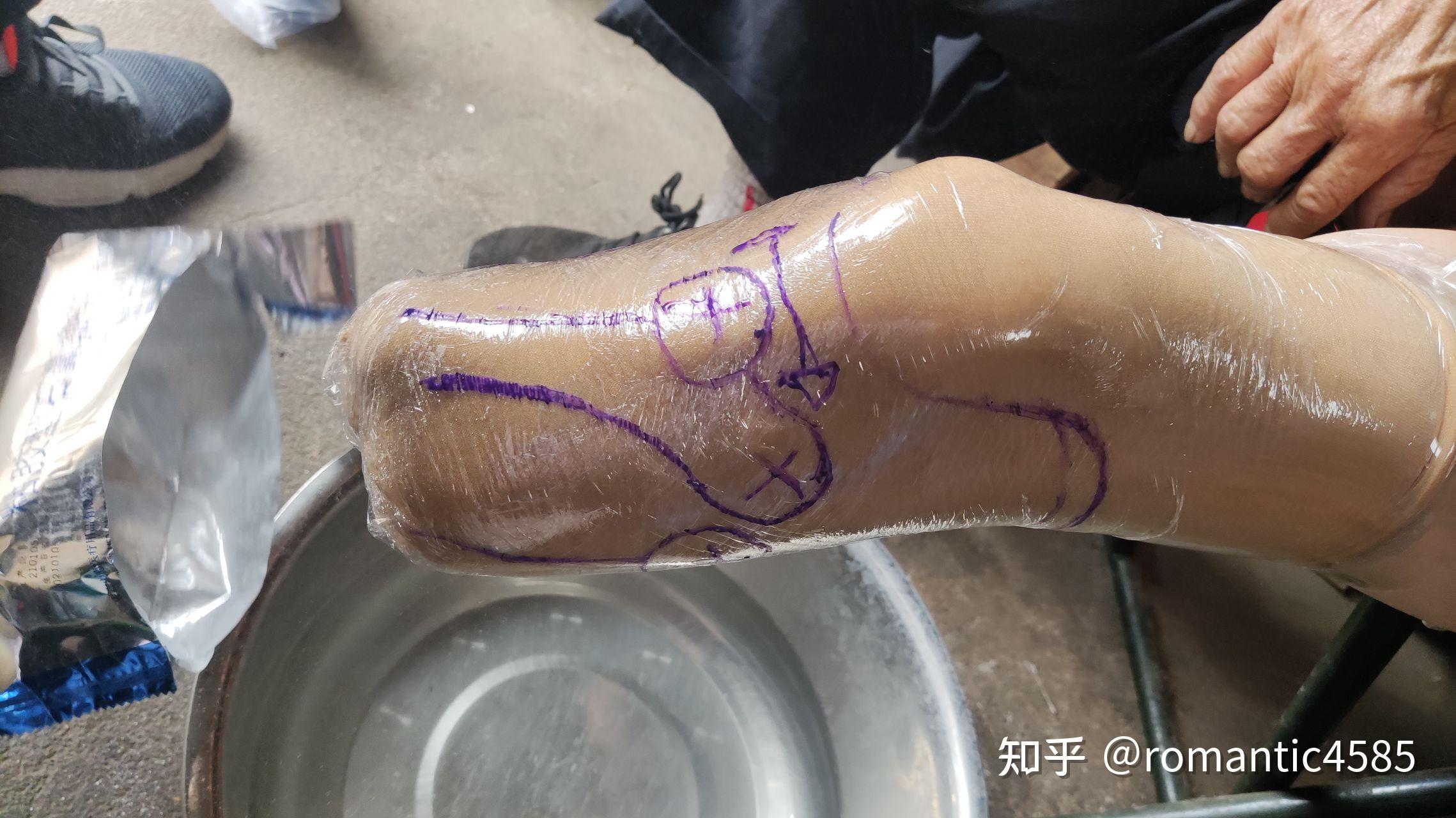 交通事故中两小腿截肢能评几级伤残?