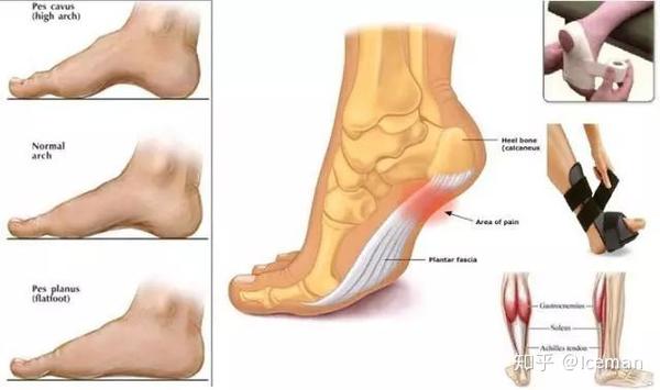 时间运动就脚疼足底筋膜炎与扁平足了解一下