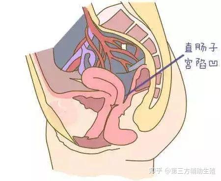 意思就是有一些液体积聚在了子宫直肠陷凹(或者我们叫道格拉斯窝)