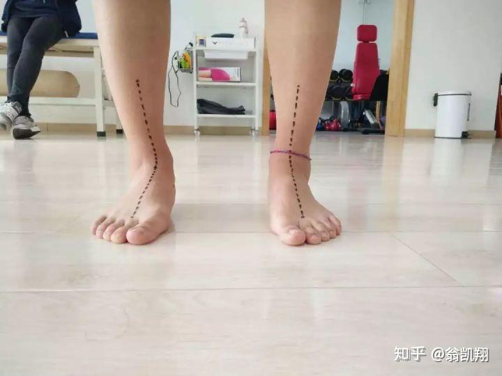 足外翻能矫正吗