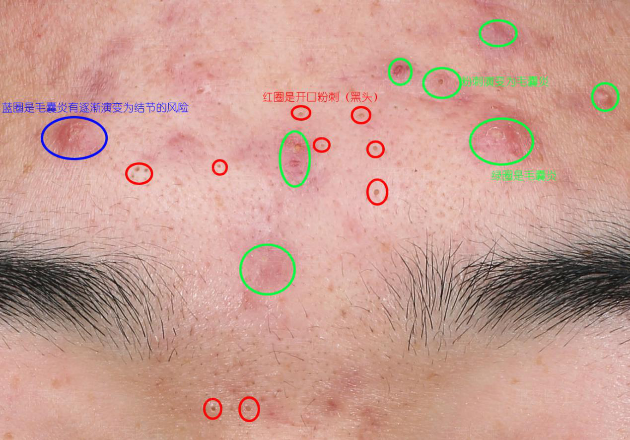 下图为同一个痤疮患者脸上呈现出的不同类型痤疮皮疹形态,是一个很好