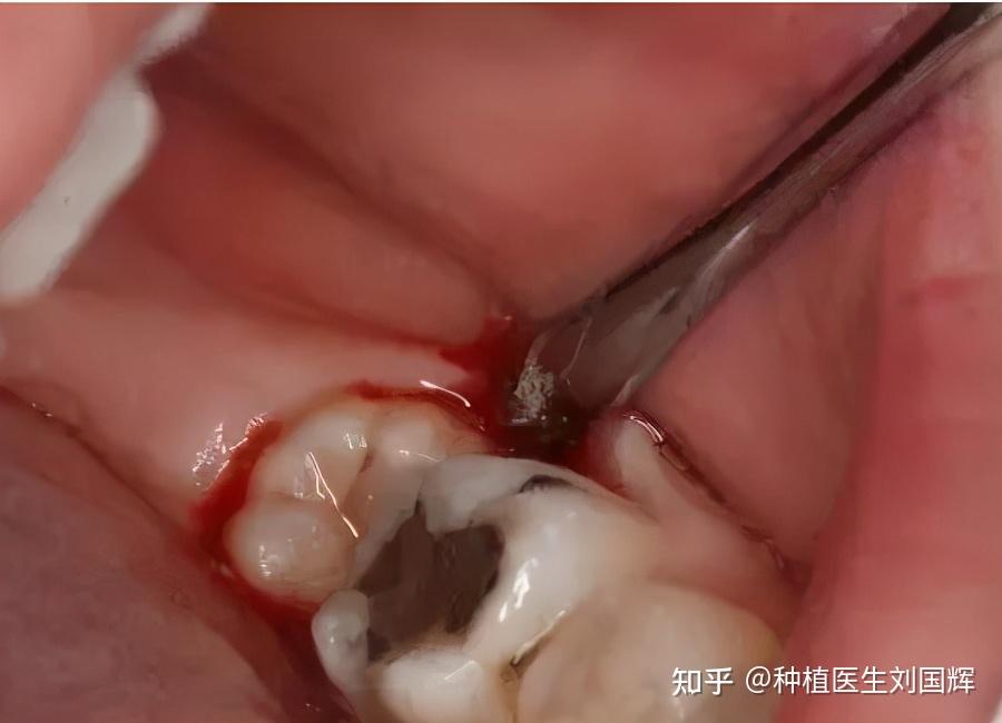 拔牙留下的牙洞会在3个月左右骨组织形成后长平,恢复正常的状态!