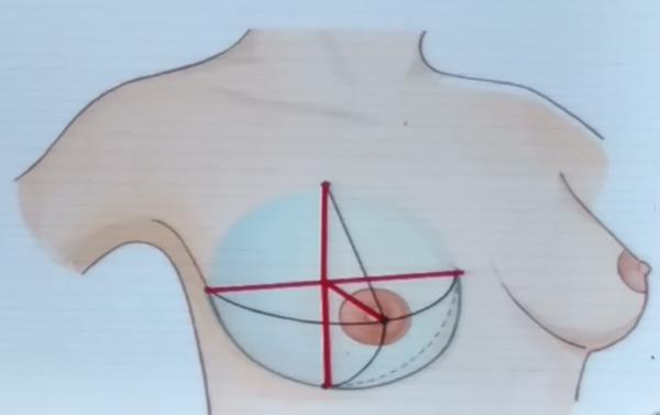 整形外科测量乳房大小的几个维度——宽度,凸度,挺度(上半极长度,下半