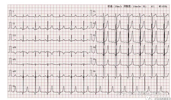 5mv,因此判定其为左心室高电压; 3,并且t波在