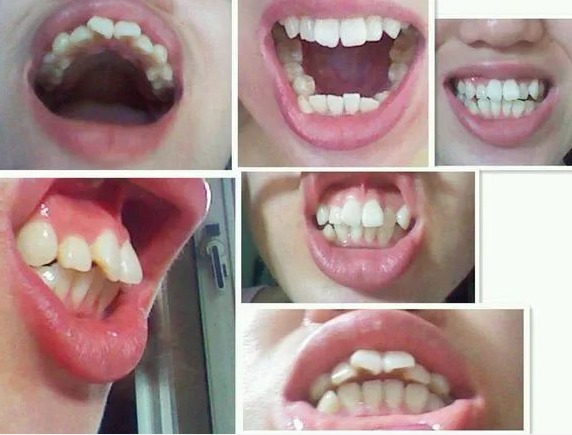 被人取笑龅牙矫正可以帮你颜值提升但要知道这2个矫牙黄金期