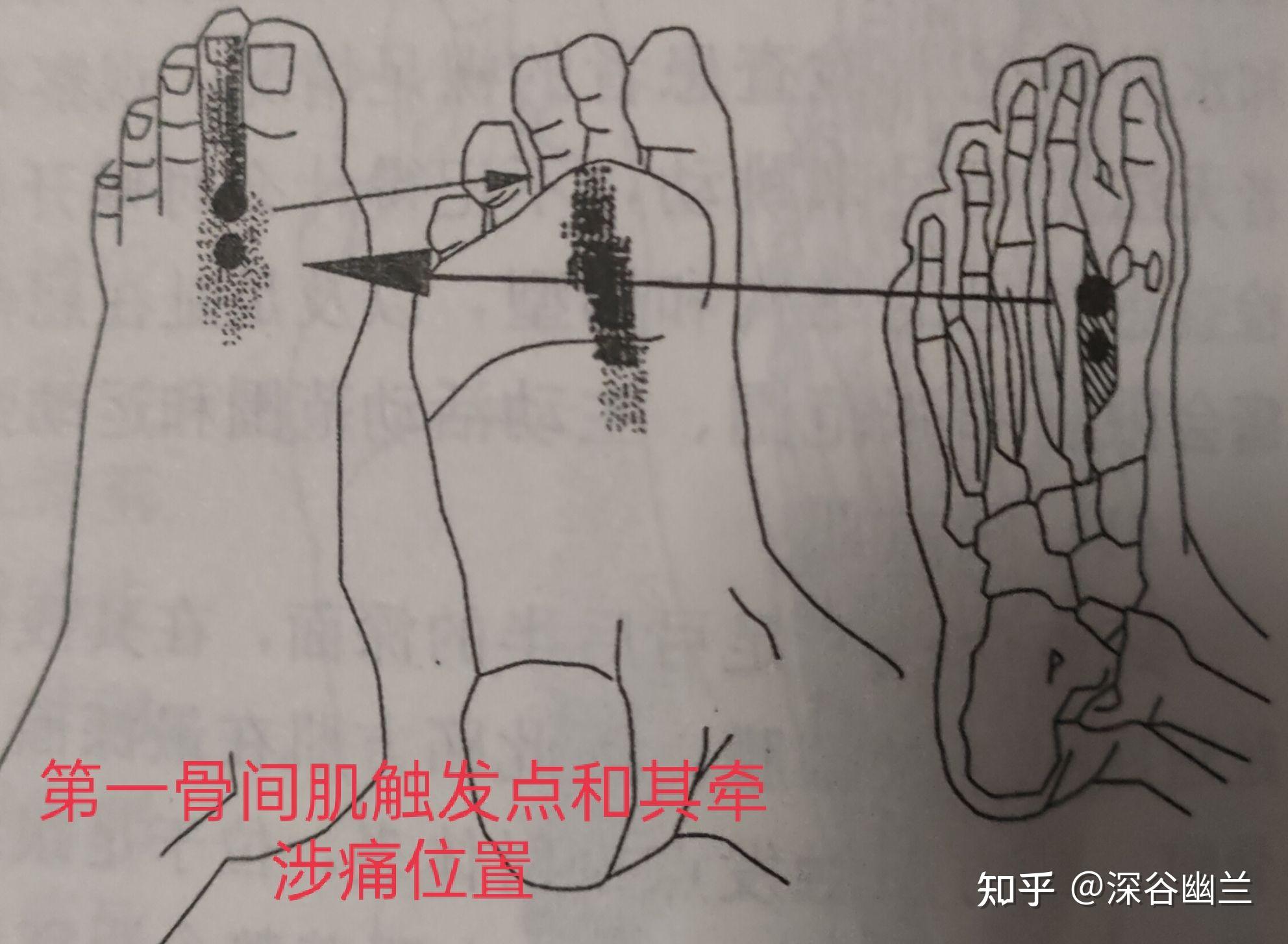 读书笔记足深层肌触发点