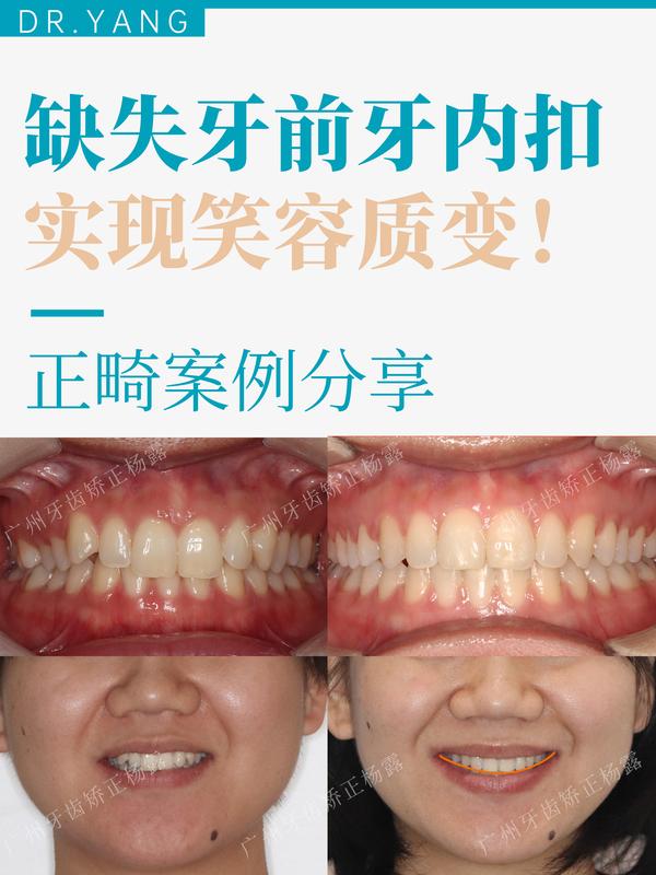 广州整牙缺失牙前牙内扣14个月时间实现笑容质变