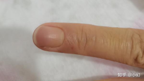 主要症状就是手指上有红疙瘩,然后会脱皮,会很痒.