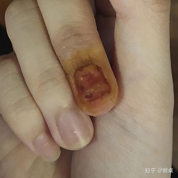 手指被门夹伤后的康复过程记录