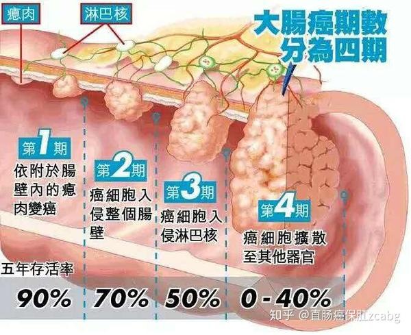 肠息肉变肠癌需要多久?哪些息肉是必须切除的?
