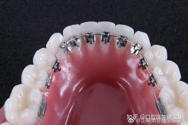 舌侧矫治器