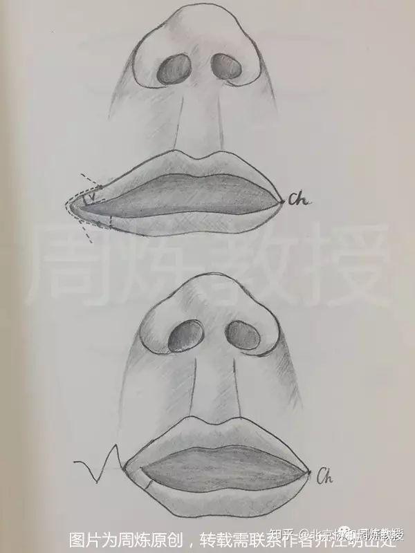 面横裂 巨口症 —中
