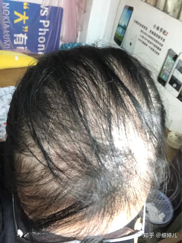 给你们看看,看这两个月的习效果如何吧 前面几张都是脱发那时的照片