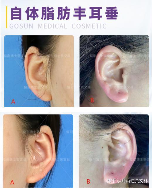 耳垂单薄丰耳垂术助你拥有饱满丰盈的耳垂