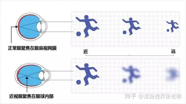 那么简单地说,它的后遗症可能出现什么,比如说比较多见的一些眩光,就